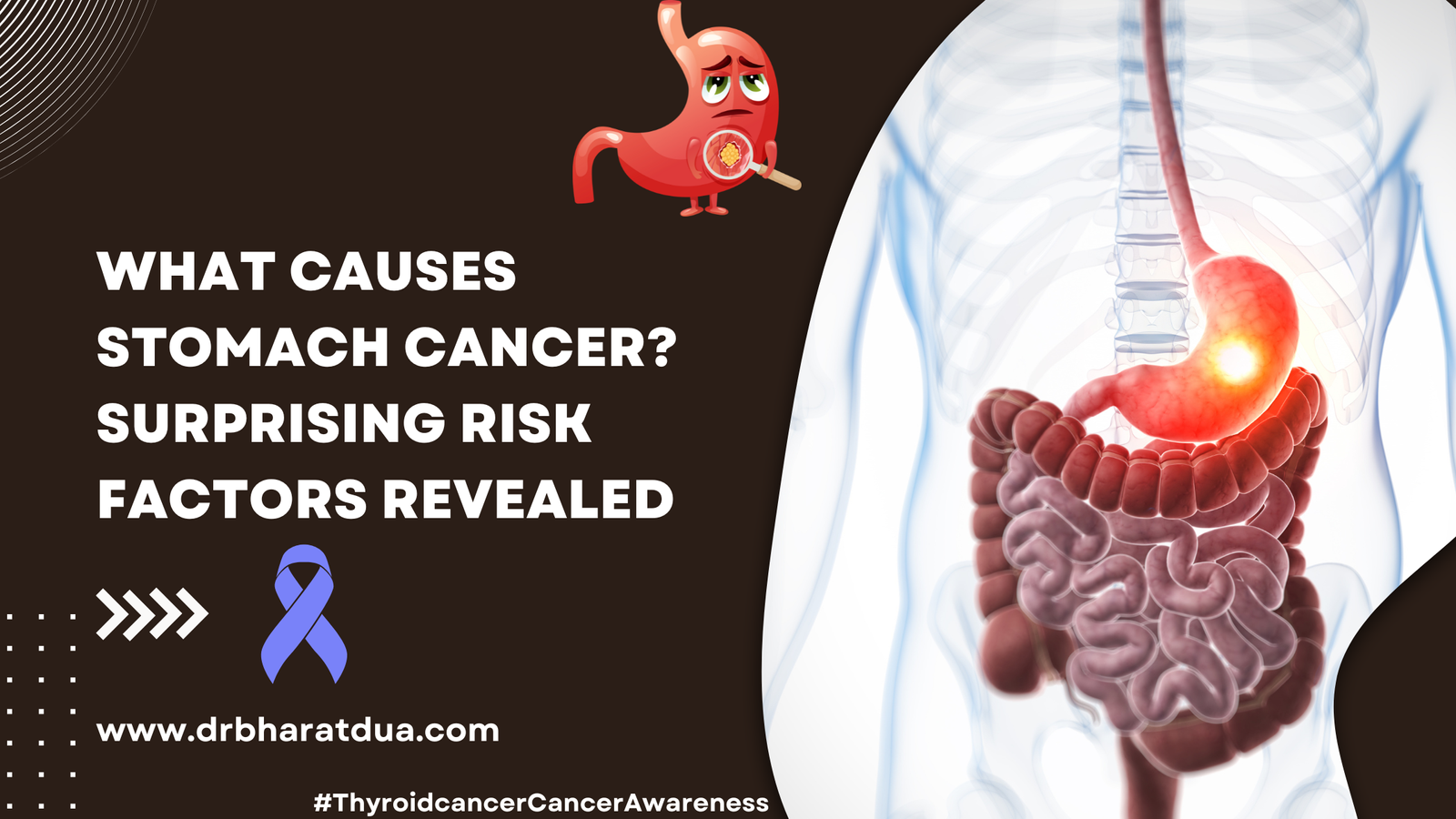 What Causes Stomach Cancer? Surprising Risk Factors Revealed